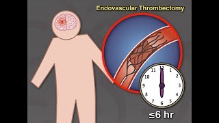 Thrombektomie 6 bis 24 Stunden nach Insult [upl. by Valenka]