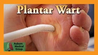 Plantar Wart Treatment  Auburn Medical Group [upl. by Yragerg508]