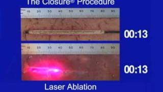 Tissue Thermal Ablation Pattern of ClosureFAST vs Laser [upl. by Aggie]