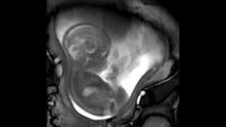 MRI scan at 21 weeks [upl. by Nosimaj]