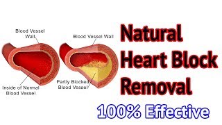 Natural Medicine for ANGIOPLASTY with out surgery [upl. by Aivonas]