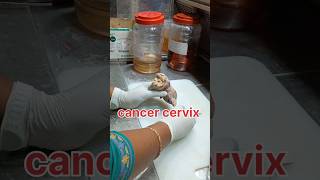 Cancer cervix specimen grossing pathology cancer cervicaltreatment cervicalcancersymptoms [upl. by Barger]