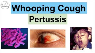 Whooping Cough Pertussis  Transmission Pathophysiology Symptoms Diagnosis Treatment [upl. by Misti194]