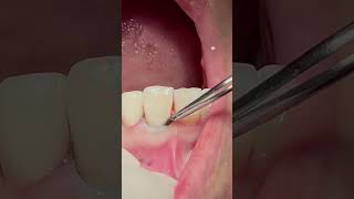 Retraction cord dentist dental teeth viral [upl. by Wiebmer678]