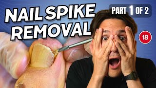 Ingrown Toenail Spike Removal part 1 of 2 [upl. by Hayarahs]