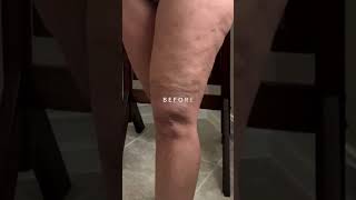 My Fascia Blaster Experience Cellulite Before amp After [upl. by Proctor]