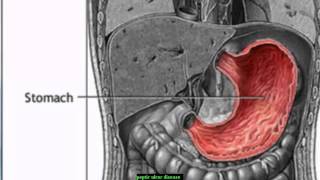 peptic ulcer disease in children [upl. by Catharine]