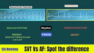 ECG Workshop SVT amp AF on simulation [upl. by Sybyl]