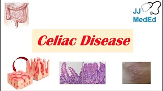 Celiac Disease amp Gluten Sensitivity Risk Factors Pathogenesis Symptoms Diagnosis Treatment [upl. by Reitrac260]