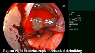 Tracheal Melanoma  Central Airway Obstruction Rigid bronchoscopic debulking [upl. by West452]