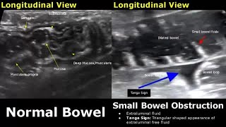 Abdominal Ultrasound Normal Vs Abnormal Images  Liver Gallbladder Pancreas Kidney Hernia USG [upl. by Maribeth]