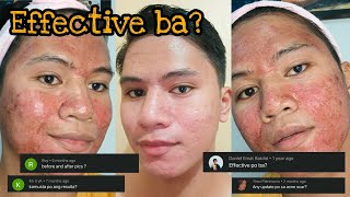 Derma Pen 3rd Session  Question and Answer About Microneedling  DYNEL BEO [upl. by Jeralee790]