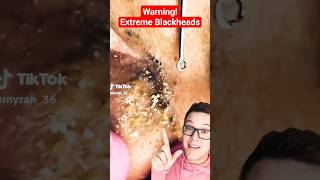 Warning EXTREME BLACKHEAD REMOVAL  How Do You Tackle This shorts [upl. by Ahseki]