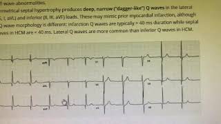 ECG changes in HCM [upl. by Ssepmet]