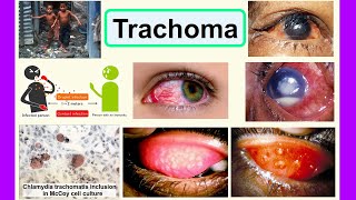 trachoma [upl. by Heron579]