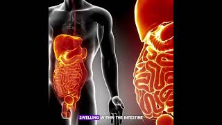 CAUSES OF INTESTINAL OBSTRUCTION [upl. by Iem]