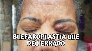 Antes da blefaroplastia eu era assim😔 Erro médico [upl. by Magnien159]