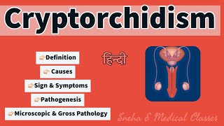 Cryptorchidism  Pathology  Microscopic and Gross Pathology  Pathogenesis [upl. by Thorwald787]