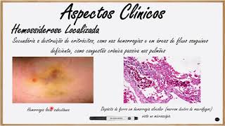 Patologia Geral  Pigmentação  Hemossiderina [upl. by Netsirc]