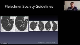 Pulmonary Nodules [upl. by Teahan]