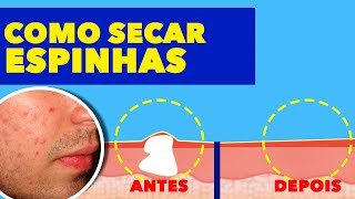 COMO FAZER GEL SECATIVO PARA ESPINHAS EM CASA [upl. by Leahcimaj]