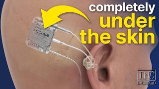 100 INVISIBLE Cochlear Implant  Acclaim by Envoy Medical [upl. by Micheline]