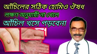 আঁচিলের সঠিক হোমিওপ্যাথিক ঔষধ  best homeopathic medicine for warts  Dr SP Goswami [upl. by Kristo]