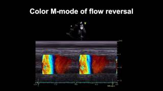 Echocardiography Essentials Detecting aortic regurgitation [upl. by Norrie756]