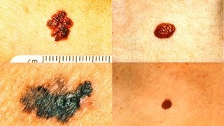 What Does Melanoma Look Like  Skin Cancer [upl. by Paxton834]