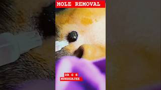 Mole removal shorts viral moleremoval drgsmukherjee moleremove trending dermatologist [upl. by Hewett]