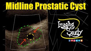 Midline Prostatic Cyst  Ultrasound  Case 302 [upl. by Sedgewinn791]