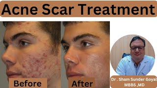 Acne Scar Treatment Results  Acne Scars  Kayakalp Laser Clinic [upl. by Hooge]