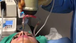 Chin Liposuction [upl. by Anaejer]