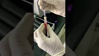 Esr westergren method laboratory testing test bloodtest khanzaki path medicalstudent [upl. by Casabonne]