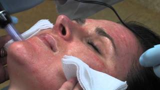 Dr Mark B Taylor Review of Dermapen Micro Needling  Gateway Aesthetics [upl. by Gradeigh]