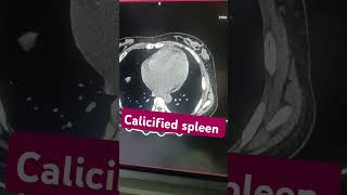 ctscan spleen calcification radiology scan interesting leaening phonk beats [upl. by Siradal585]