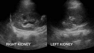 Right Flank Pain in 17 yo G1P0 16 weeks gestation [upl. by Murielle380]