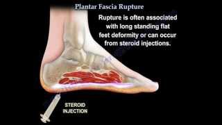 Plantar Fascia Rupture  Everything You Need To Know  Dr Nabil Ebraheim [upl. by Dor60]