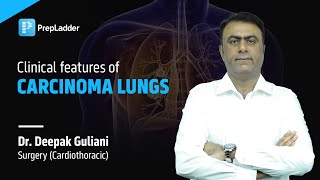 Clinical features of Carcinoma Lungs  Surgery Cardiothoracic [upl. by O'Mahony]