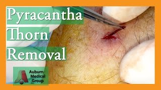 Foreign Body Removal of Pyracantha Thorn  Auburn Medical Group [upl. by Heyer762]