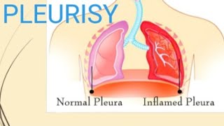 Pleura  Pleurisy Pleuritis  Pleurisy Nursing Management [upl. by Eustacia]