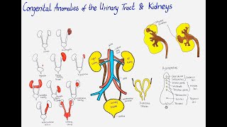 congenital anomalies of the urinary tract and kidneys [upl. by Cadel77]