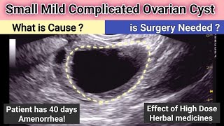 Ultrasound Mild Complicated Small Ovarian Cyst  what is Cause  is Surgery needed [upl. by Ybok708]