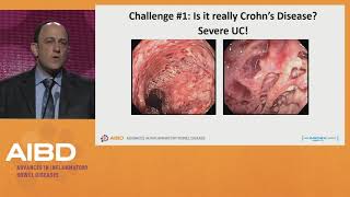 Challenges in the treatment of severe Crohns disease [upl. by Rhodie]