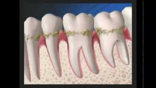 Cavitron Ultrasonic Scaling [upl. by Atneuqal]