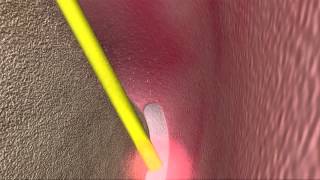 Laser Periodontal Therapy WPT™ Animation [upl. by Artina]