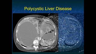 CT Evaluation of Liver Masses Key Differential Diagnosis Findings  Part 1 [upl. by Hayilaa521]