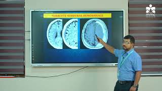 RADIODIAGNOSIS INTRACRANIAL HAEMORRHAGES [upl. by Sybley]