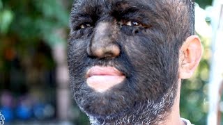 Meet the Worlds Hairiest Man [upl. by Fulmis]