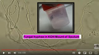 Fungal branched hyphae in KOH mount of Sputum Microscopy [upl. by Celine]